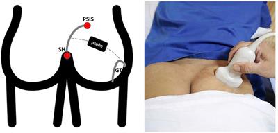 Ultrasound-Guided Measurement of Piriformis Muscle Thickness to Diagnose Piriformis Syndrome